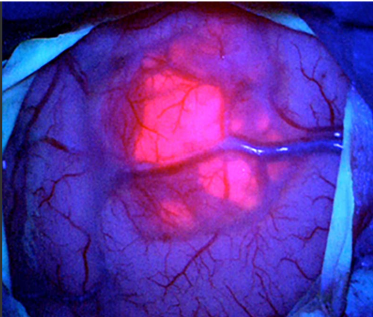 Chirurgie sous fluorescence